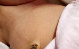 新生儿肚脐脱落后又结痂是正常现象还是异常感染？家长该如何正确护理？