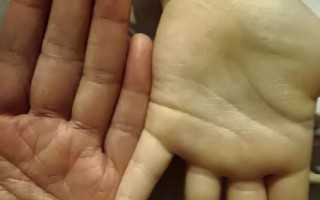 新生儿手发白没血色是正常现象还是疾病信号？需警惕哪些潜在问题？