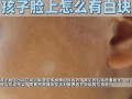 儿童脸上白色糠疹图片是哪种皮肤病？需要治疗吗？