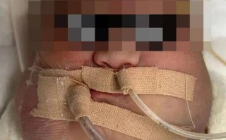 新生儿重度窒息后脑水肿，如何有效干预以减少神经后遗症风险？