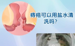 孕期痔疮发作，用盐水清洗到底安不安全？会不会刺激胎儿或加重症状？