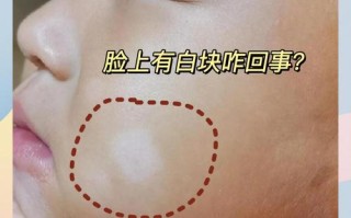 儿童脸上出现白斑是白癜风还是其他皮肤病？家长该如何科学应对？