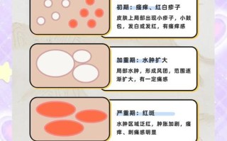 儿童荨麻疹，家长该注意哪些关键事项？