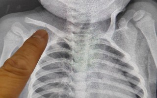 新生儿锁骨不对称图片是正常现象吗？需要就医检查吗？
