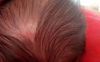 新生儿头皮红色疙瘩是湿疹还是毛囊炎？该怎么护理才好？