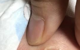 新生儿脐带掉落后流脓是感染了吗？该怎么处理才正确？