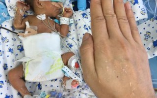 新生儿先天性食道闭锁的成因、早期识别与治疗策略有哪些关键点？