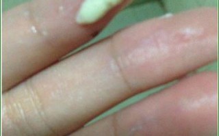 怀孕期间白带像豆腐渣是感染了吗？对胎儿有影响吗？