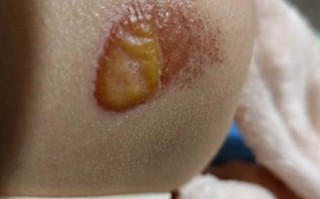 新生儿脓疱疹是否需要住院治疗，取决于病情严重程度吗？