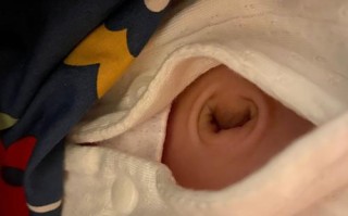 新生儿肚脐突出用硬币矫正靠谱吗？这样处理会不会有感染风险？