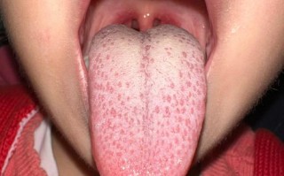 新生儿重舌初症状图片有哪些典型表现？如何辨别与其他口腔异常的区别？