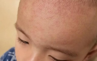 新生儿额头不烫身上烫是正常现象还是生病信号？体温异常该如何判断处理？