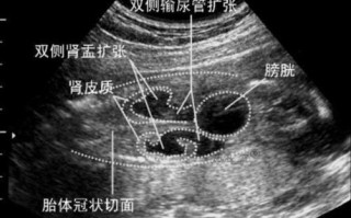 新生儿肾盂分离5mm要紧吗？