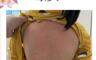 儿童免疫系统疾病早期症状