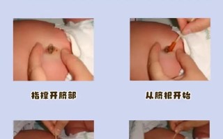 新生儿肚脐护理到底该怎么做才能避免感染和促进愈合？