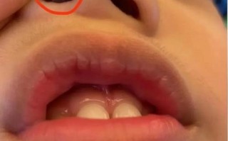 儿童鼻内肉红肿堵塞怎么办？