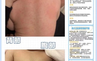 新生儿全身红多久能好？一般几天消退？需要就医吗？