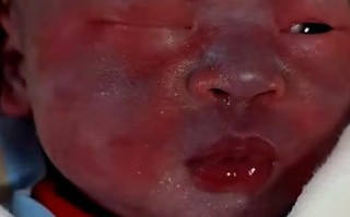 新生儿经常脸通红是正常现象还是健康预警？需关注哪些异常信号？