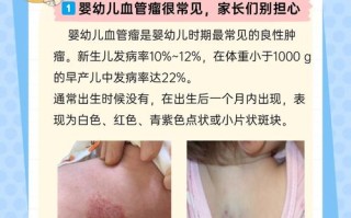 儿童过敏性紫癜该挂什么科？挂号前需了解这些关键信息！