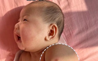 新生儿打卡介苗后有哪些常见反应？