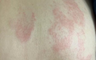 孕期胆酸高有什么症状