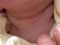 新生儿脖子褶皱处破皮
