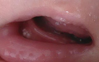 新生儿上颚小白点是什么原因？需要担心吗？