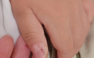 儿童甲亢症状早期症状