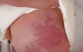 新生儿肚子上有红块图，是胎记还是皮肤过敏？需要担心吗？