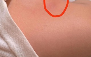 新生儿大腿肌肉摸到硬块是正常现象还是疾病信号？