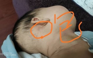 新生儿耳朵后出现红疙瘩是湿疹还是毛囊炎？需要怎么处理？