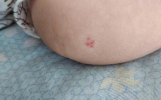 新生儿皮肤薄血管明显，是正常现象还是需要警惕的健康信号？