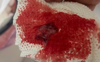 怀孕期间子宫内出现积血，会对胎儿发育造成哪些影响？