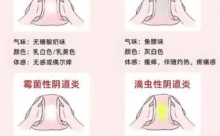 孕期分泌物多痒怎么办？是正常现象还是感染信号？如何安全缓解不适？