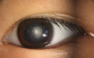 新生儿眼睛白眼球发灰是正常现象还是异常信号？需警惕哪些潜在健康问题？