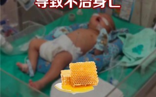 新生儿误食蜂蜜后，家长该如何正确处理？需要紧急就医吗？