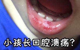 儿童反复口腔溃疡是缺维生素还是免疫力差？