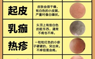 儿童湿疹反复发作，究竟是什么在背后作祟？