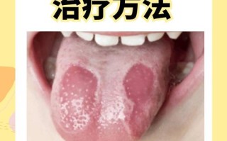 儿童地图舌是何原因引起？