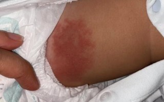 新生儿尿里有点红是上火还是疾病信号？需要担心吗？