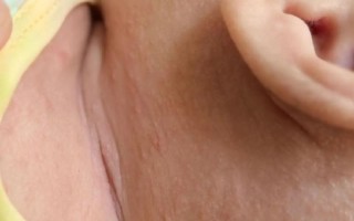 新生儿长湿疹能打预防针吗？