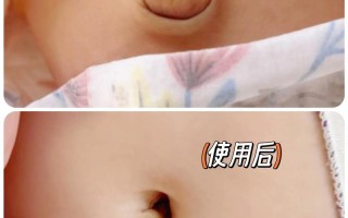 新生儿肚脐凸出是啥原因？