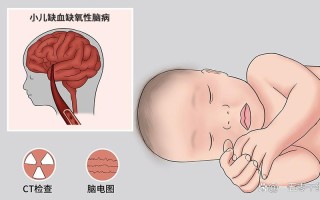 新生儿缺氧缺血性脑病诊断标准有何更新？