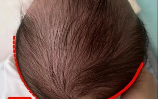 孕期头偏大怎么办？需要干预吗？