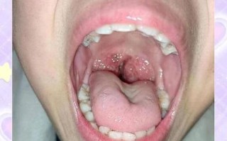 8岁儿童扁桃体手术全过程是怎样的？