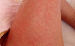 新生儿腿上一大片红色是胎记还是血管瘤？需要担心吗？