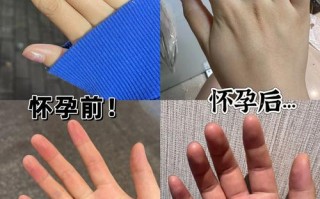 怀孕期间手肿是正常现象吗？需要警惕哪些潜在问题？