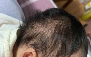 新生儿尾椎骨处的胎毛是正常生理现象还是异常发育信号？