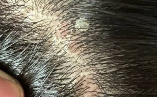 孕期 头皮溢脂性皮炎