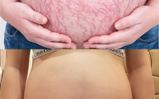 孕期几时开始长妊娠纹？